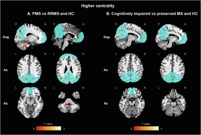 Fig. 3: SPM12 analysis showing voxel-wise differences in centrality between MS patients, according to their clinical phenotype and cognitive status, and HC.