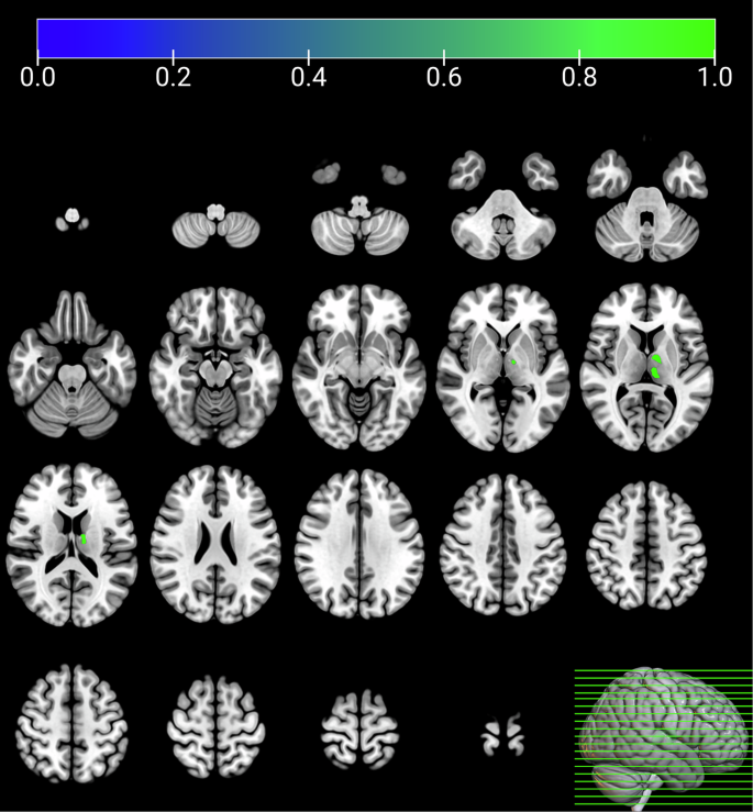 Fig. 1: Differences in gray matter volume between healthy controls and individuals with methamphetamine use disorder.