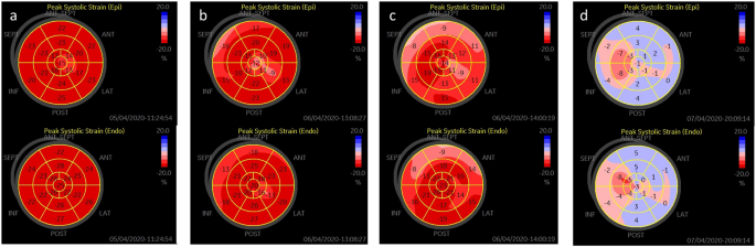 Could strain echocardiography help to assess systolic function in  critically ill COVID-19 patients?