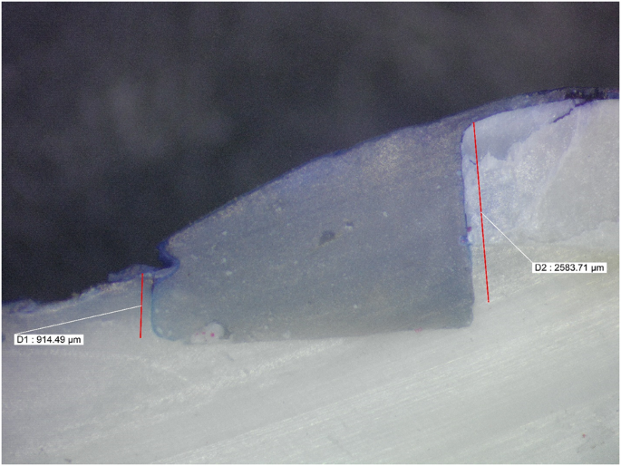 Comparative evaluation on the effect of different cavity disinfectant nano  gels; Chlorohexidine, Propolis, Liquorice versus Diode Laser in terms of  composite microleakage (comparative in vitro study) | BDJ Open