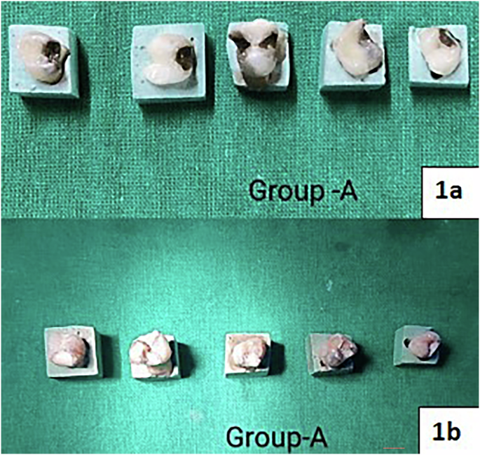 Comparative evaluation on the masking ability of different tooth colored restoration over blackish discoloration caused by 38% silver diamine fluoride: an in -vitro study