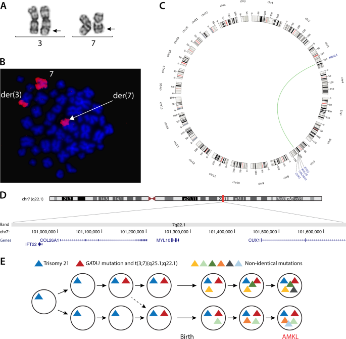 Fig. 1: A shared somatic translocation in monozygotic twins with Down syndrome and acute megakaryoblastic leukemia (AMKL).