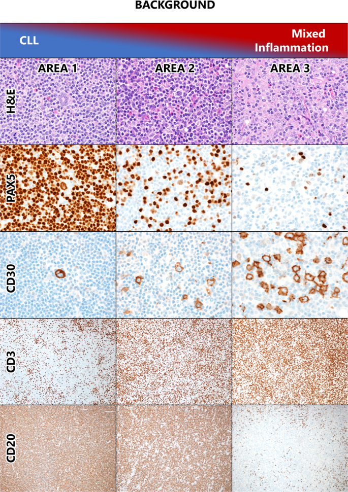 Fig. 2: Case with areas of both CLL-HRS and CHL.