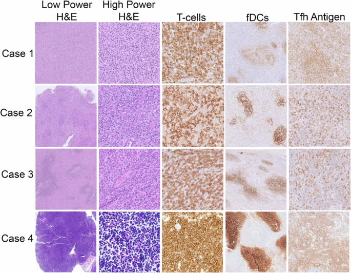 Fig. 1: Examples of pathological visualization of available AITL cases.