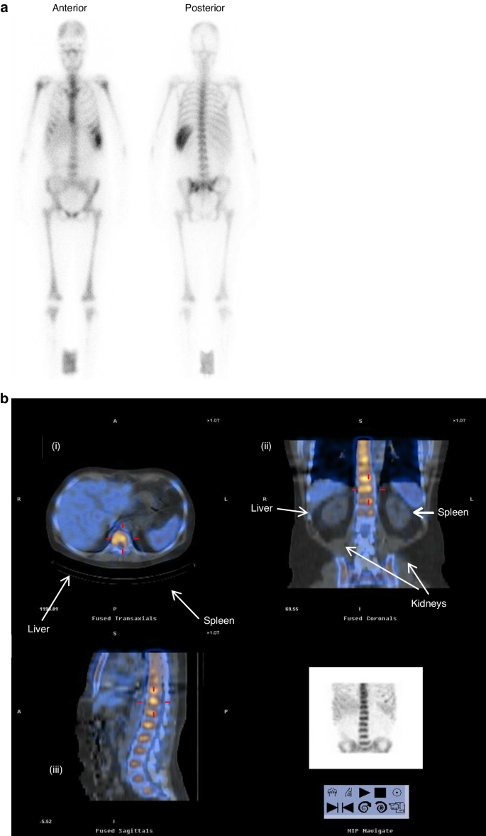 Fig. 2: Planar and SPECT-CT gamma camera images post 111In-antiCD66 infusion.