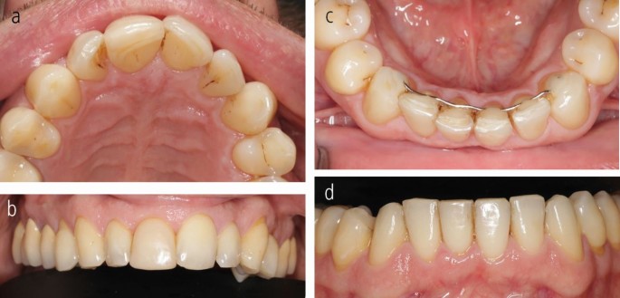 Dentures Teeth In French  . Denture Costs Vary And Most Insurance Companies Can Cover The Cost Of Dentures.