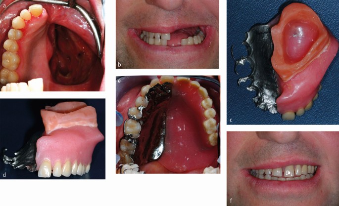 Oral Cancer Rehabilitation