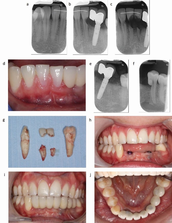 How To Assess And Manage External Cervical Resorption British Dental Journal