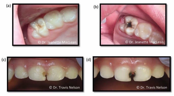 The Use Of Silver Diamine Fluoride Sdf In Dental Practice British Dental Journal The Use Of Silver Diamine Fluoride Sdf In Dental Practice British Dental Journal