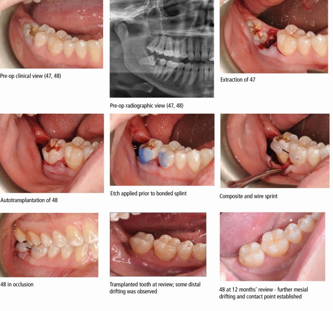 Autotransplantation Of Third Molars A Literature Review And Preliminary Protocols British Dental Journal Autotransplantation Of Third Molars A Literature Review And Preliminary Protocols British Dental Journal