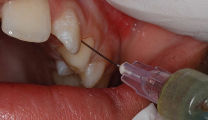 Techniques for effective local anaesthetic administration for the paediatric patient | British Dental Journal Techniques for effective local anaesthetic administration for the paediatric patient | British Dental Journal