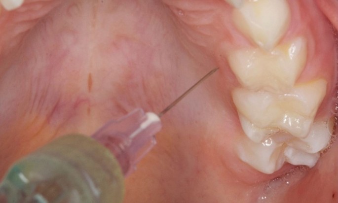Techniques for effective local anaesthetic administration for the paediatric patient | British Dental Journal Techniques for effective local anaesthetic administration for the paediatric patient | British Dental Journal