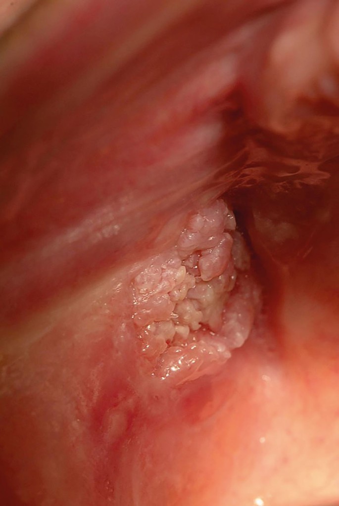 late squamous cell carcinoma