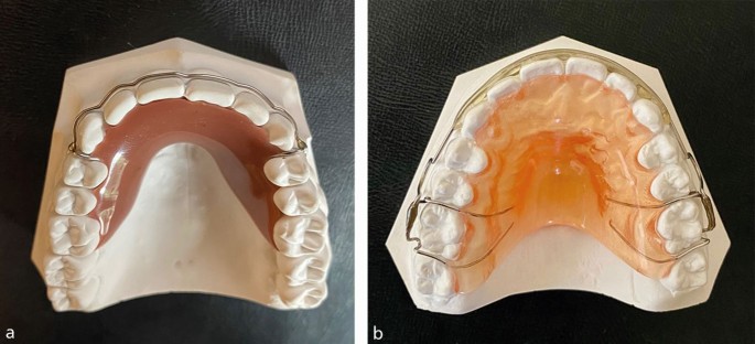 Removable Orthodontic Retainers Practical Considerations British Dental Journal