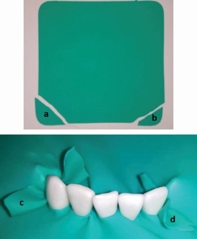 Placement modifications | British Dental Journal