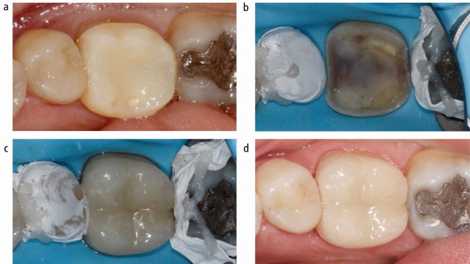 Predictable bonding of adhesive indirect restorations: factors for success  | British Dental Journal