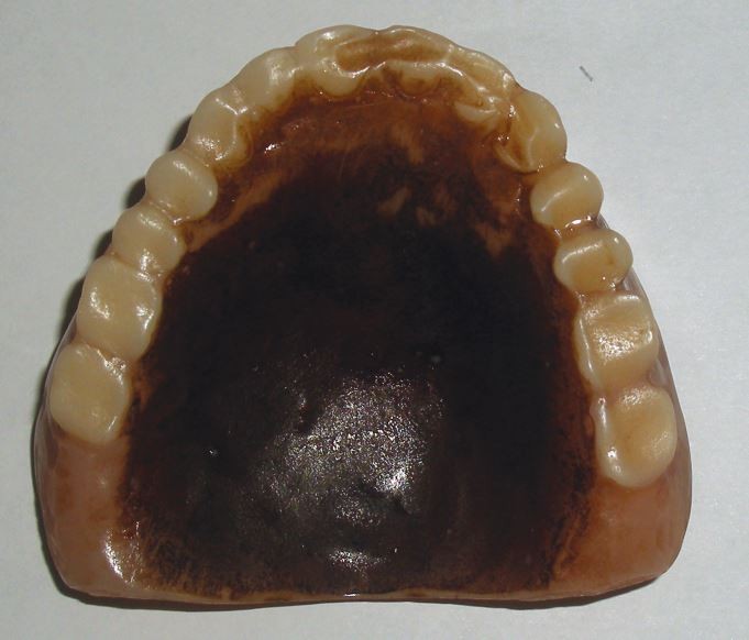 Half and half smoker's melanosis | British Dental Journal