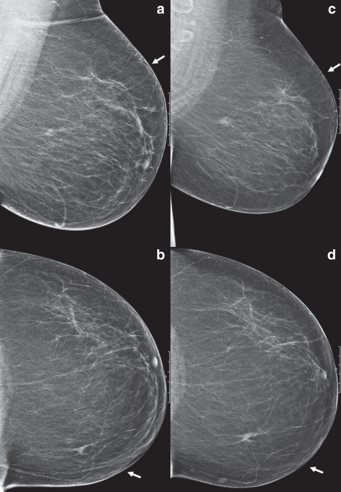 Delayed Breast Cancer Diagnosis After Repeated Recall At Biennial Screening Mammography An Observational Follow Up Study From The Netherlands British Journal Of Cancer