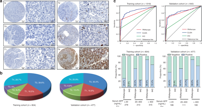 Fig. 2: Representative images for AFP RNAscope in paraffin-embedded HCC samples.