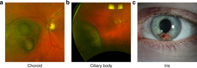 Fig. 1: Uveal Melanoma Locations.