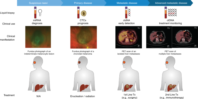 Fig. 4: Suggested applications of liquid biopsy for the management of uveal melanoma.