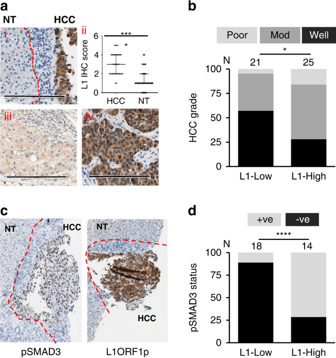 Fig. 2: Immunohistochemical (IHC) analysis of L1 ORF1p in HCC and its association with clinical features.