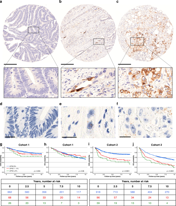 Fig. 1: Immunohistochemistry, in situ hybridization and Kaplan-Meier survival analyses of uroplakin-2.