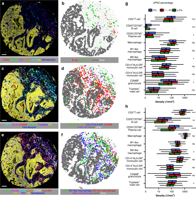 Fig. 2: Multiplex-immunohistochemistry, image analysis, and immune cell density analysis for UPK2-positive colorectal cancer.