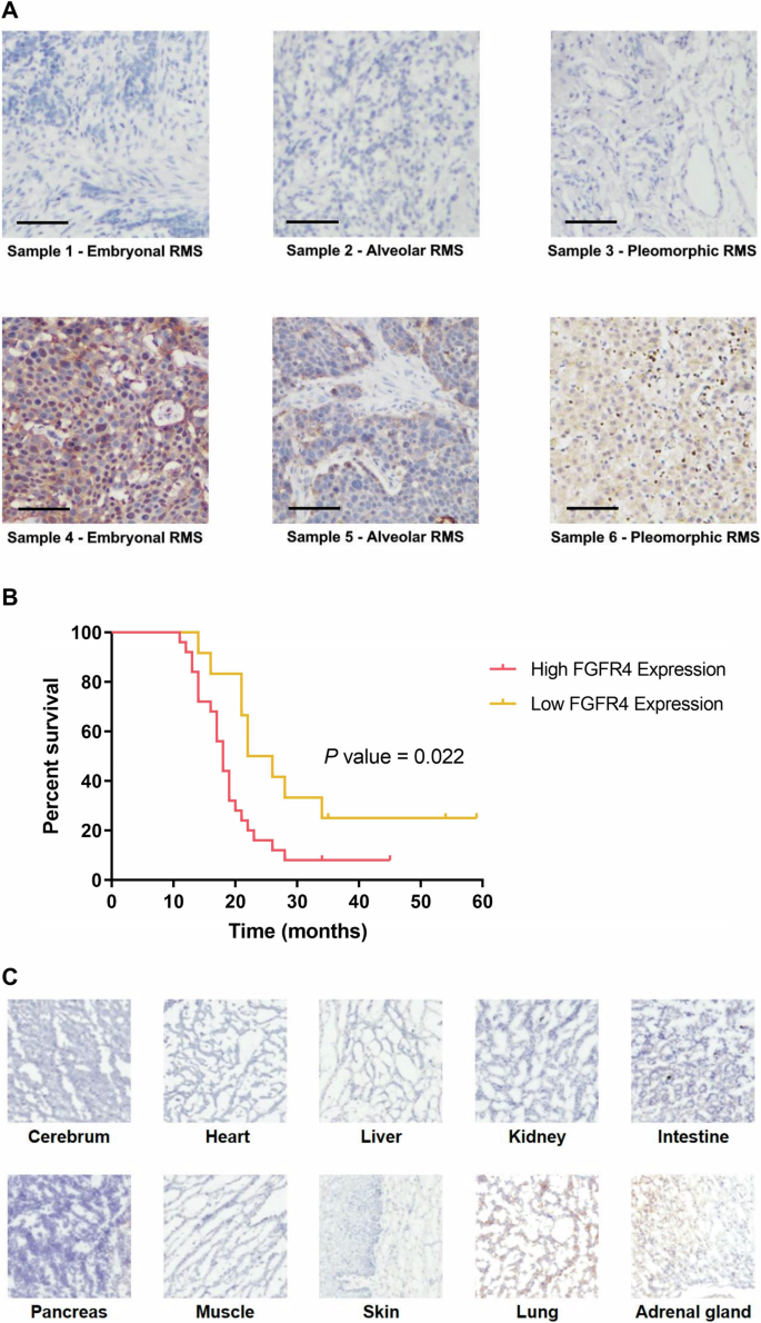 Fig. 1: Pattern of fibroblast growth factor receptor 4 (FGFR4) expression in human rhabdomyosarcoma (RMS) samples and human normal tissues.
