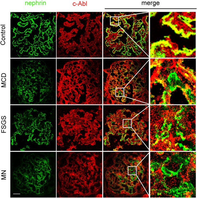Fig. 1: The expression of nephrin and c-Abl in glomeruli of participants.