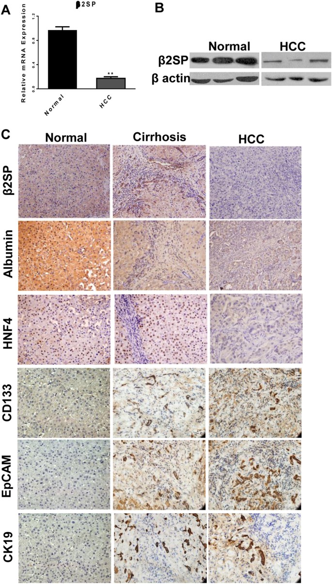 Fig. 1: The expression of β2 spectrin correlated with hepatocyte differentiation in the patients with liver cirrhosis and HCC.