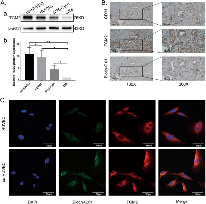 Fig. 3: Expression of TGM2 and co-localization of GX1-receptor and TGM2 in cells and tissue of gastric cancer.
