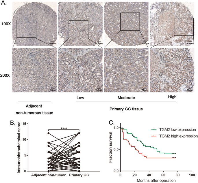 Fig. 4: TGM2 is significantly up-regulated in gastric cancer, and high TGM2 expression indicates poor prognosis.