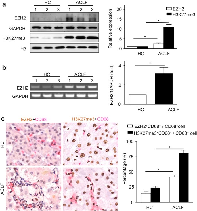 Fig. 1: EZH2 and H3K27me3 production in ACLF patients.