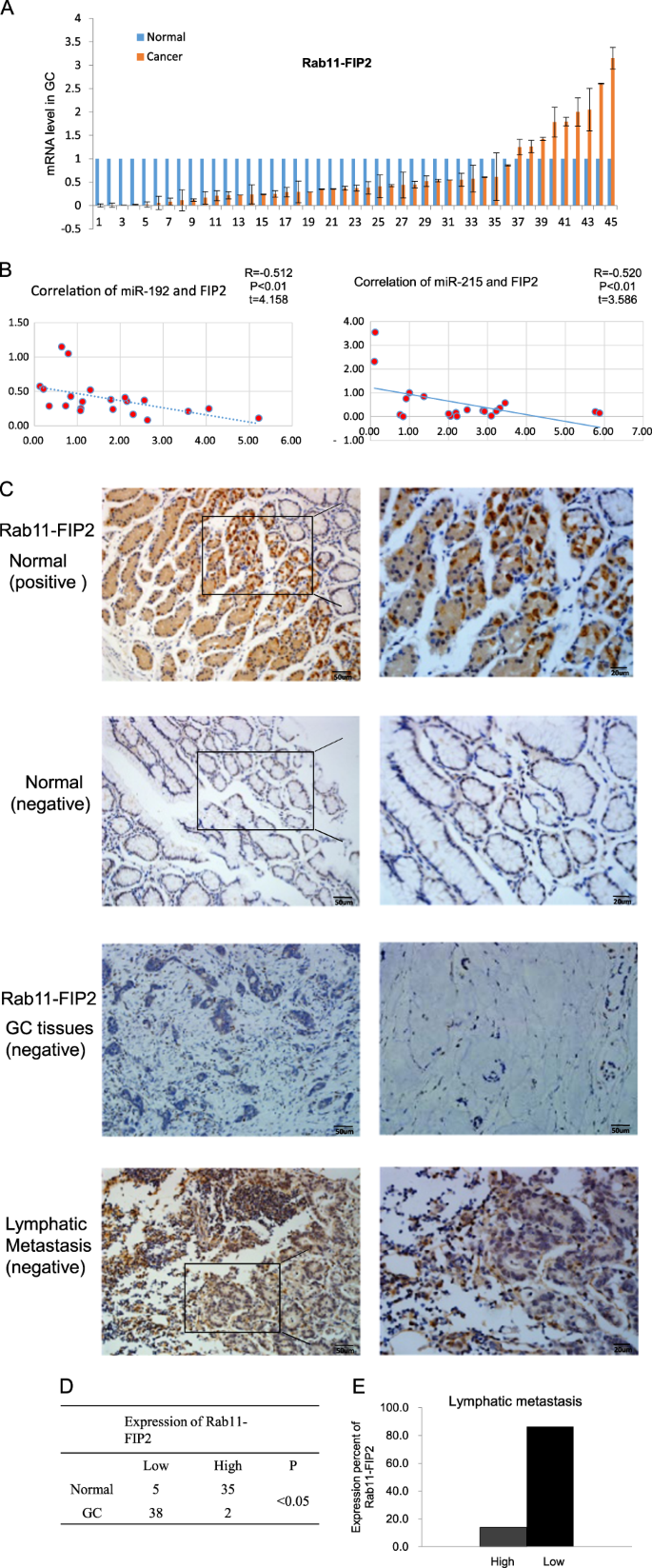 Inhibition Of The Mir 192 215 Rab11 Fip2 Axis Suppresses Human Inhibition Of The Mir 192 215 Rab11