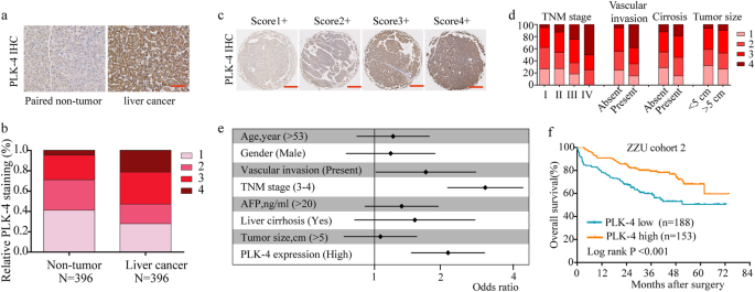 Fig. 4: PLK-4 expression is positive associated with poor prognosis of HCC.