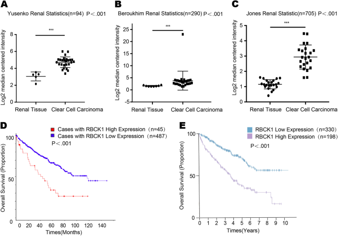 Fig. 1: RBCK1 is highly expressed in RCC tissues and correlates with poor prognosis.