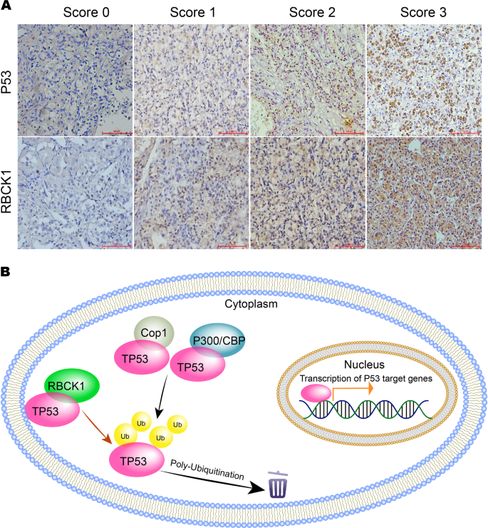 Fig. 9: Immunohistochemistry examination of RBCK1 and p53 expression in RCC tissues.