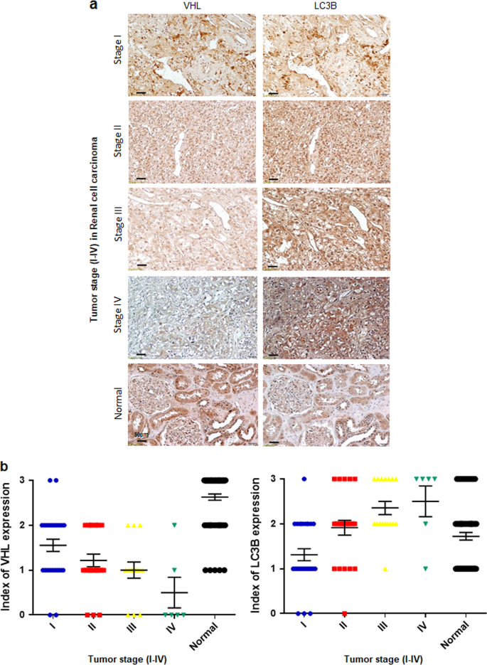 Ubiquitination Of Map1lc3b By Pvhl Is Associated With Autophagy And Cell Death In Renal Cell Carcinoma Cell Death Disease