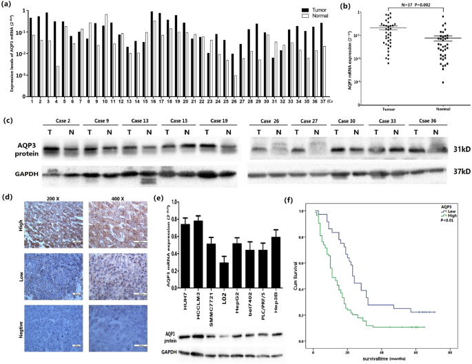 Fig. 1: AQP3 expression in HCC samples and cell lines.