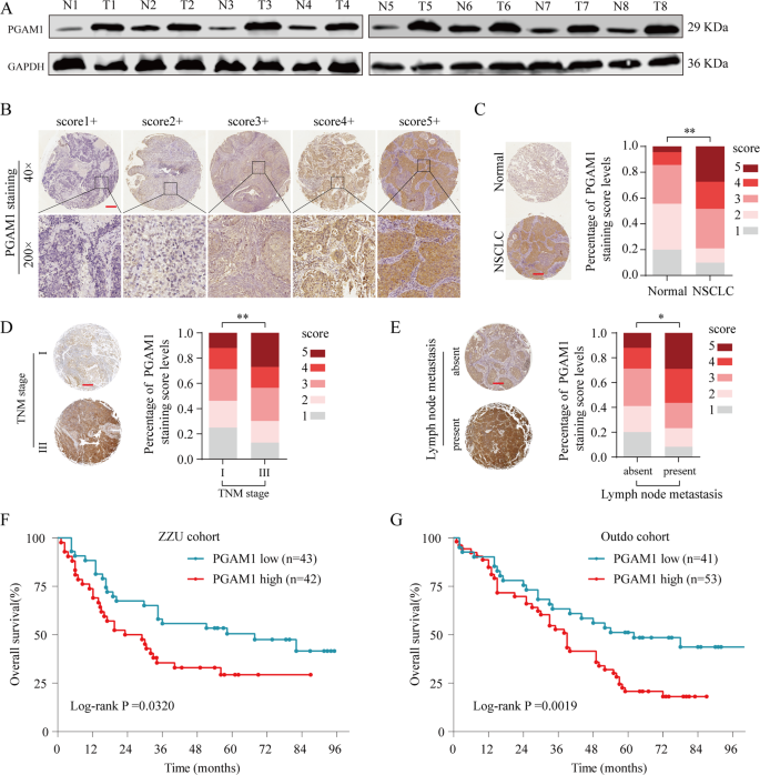 Fig. 2: PGAM1 is upregulated in NSCLC tissues and associated with poor prognosis in TMA cohort.