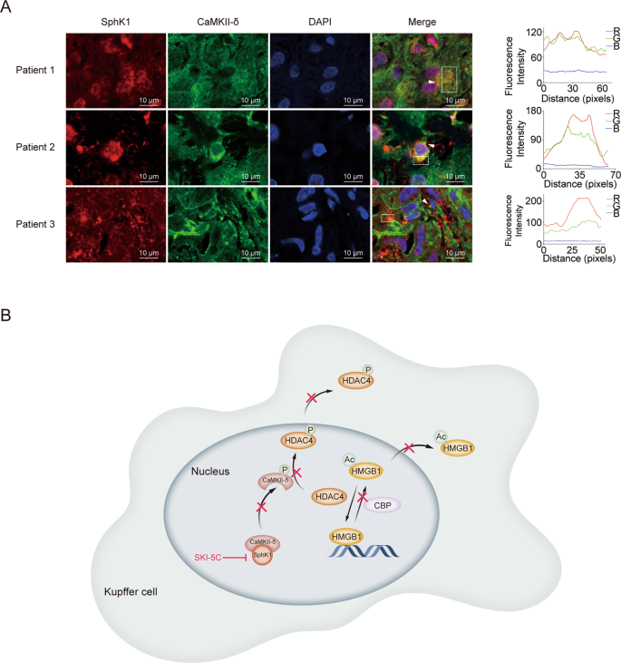 Fig. 5: SphK1 colocalizes with CaMKII-δ in the liver of patients with sepsis-associated liver injury.