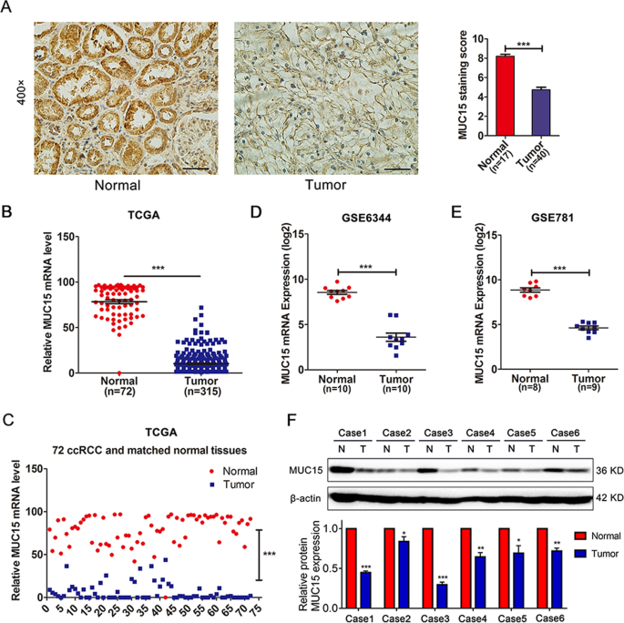 Fig. 1: Expression of MUC15 in RCC and normal kidney tissues.