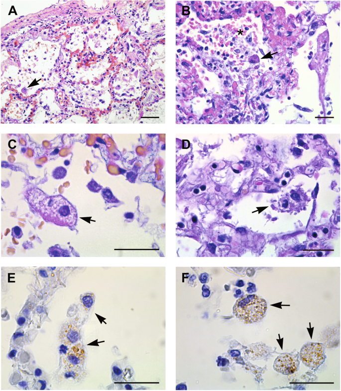 Fig. 5: Histopathological changes of lung tissue from COVID-19 patients.