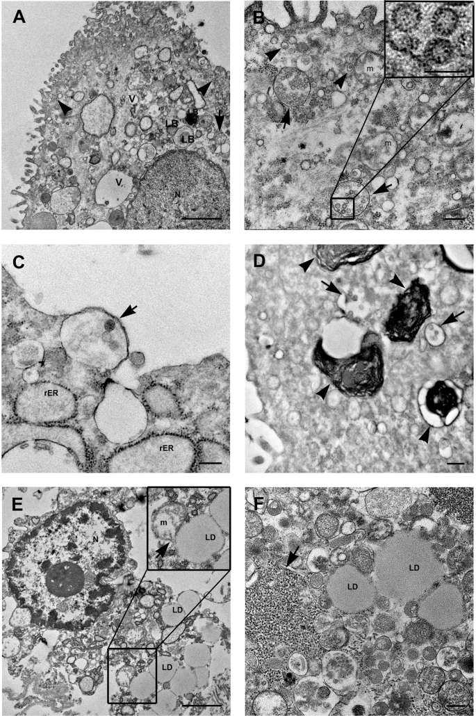 Fig. 6: SARS-Cov-2 detecting on lung tissue from COVID-19 patients by transmission electron microscopy.
