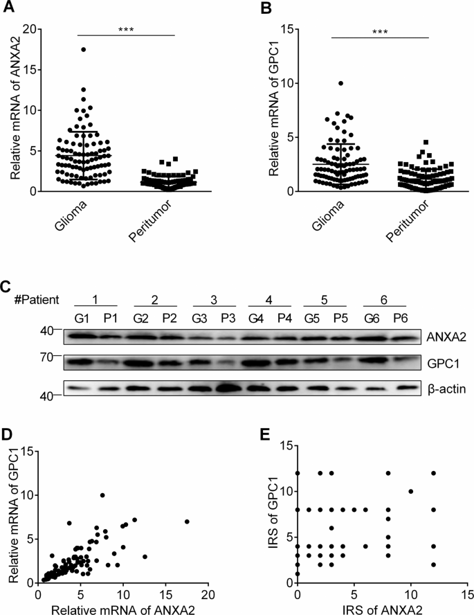 Overexpression Of Annexin Promotes Proliferation By Forming A Glypican 1 C Myc Positive Feedback Loop Prognostic Significance In Human Glioma Cell Death Disease
