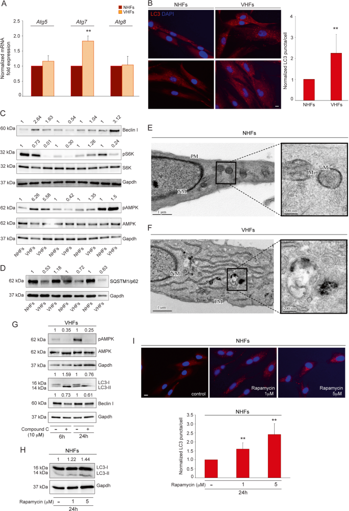 is glutathione good for vitiligo A protective role for autophagy in vitiligo