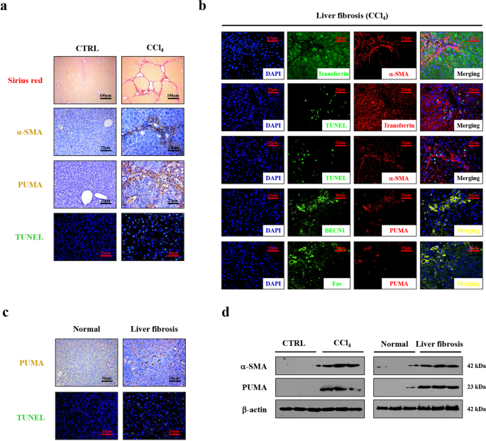 Fas/FasL mediates NF-κBp65/PUMA-modulated hepatocytes apoptosis via  autophagy to drive liver fibrosis | Cell Death & Disease