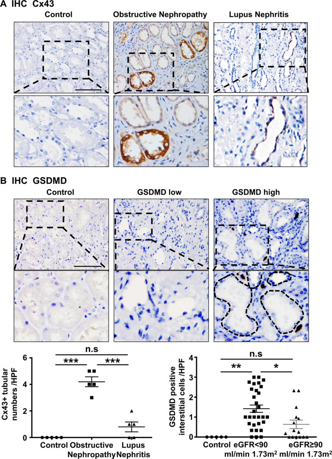 Fig. 7: The expression of Cx43 and GSDMD genes was associated with renal function in human obstructive nephropathy.