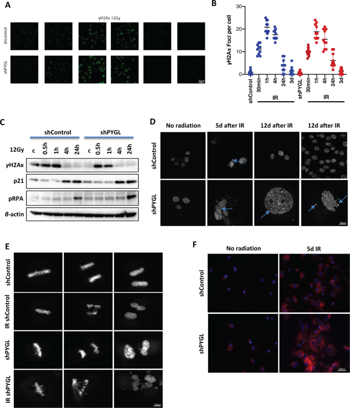 Fig. 3: Ionising radiation (IR) induced mitotic catastrophe after downregulation of glycogen phosphorylase liver isoform (PYGL).